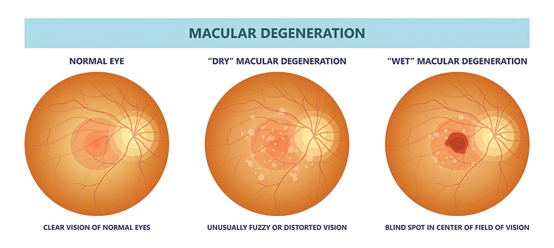 Macular Degeneration