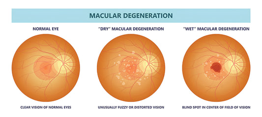 Macular Degeneration