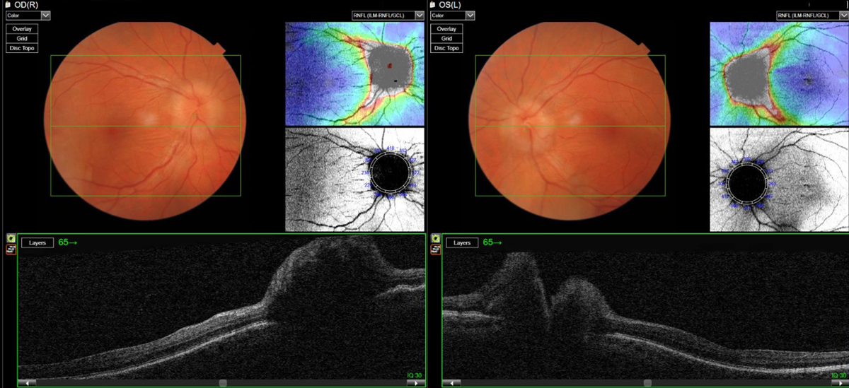 De-identified fundus photographs and OCT scans showing the optic nerve appearance observed during an eye examination at City Optics Nepean Village