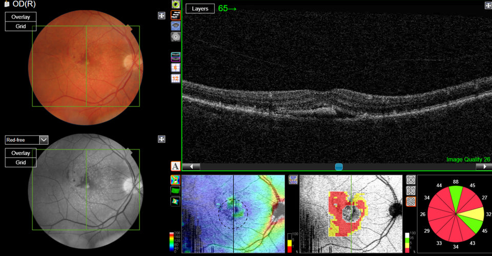 De-identified fundus photograph and OCT retinal scans captured during an eye examination at City Optics Penrith