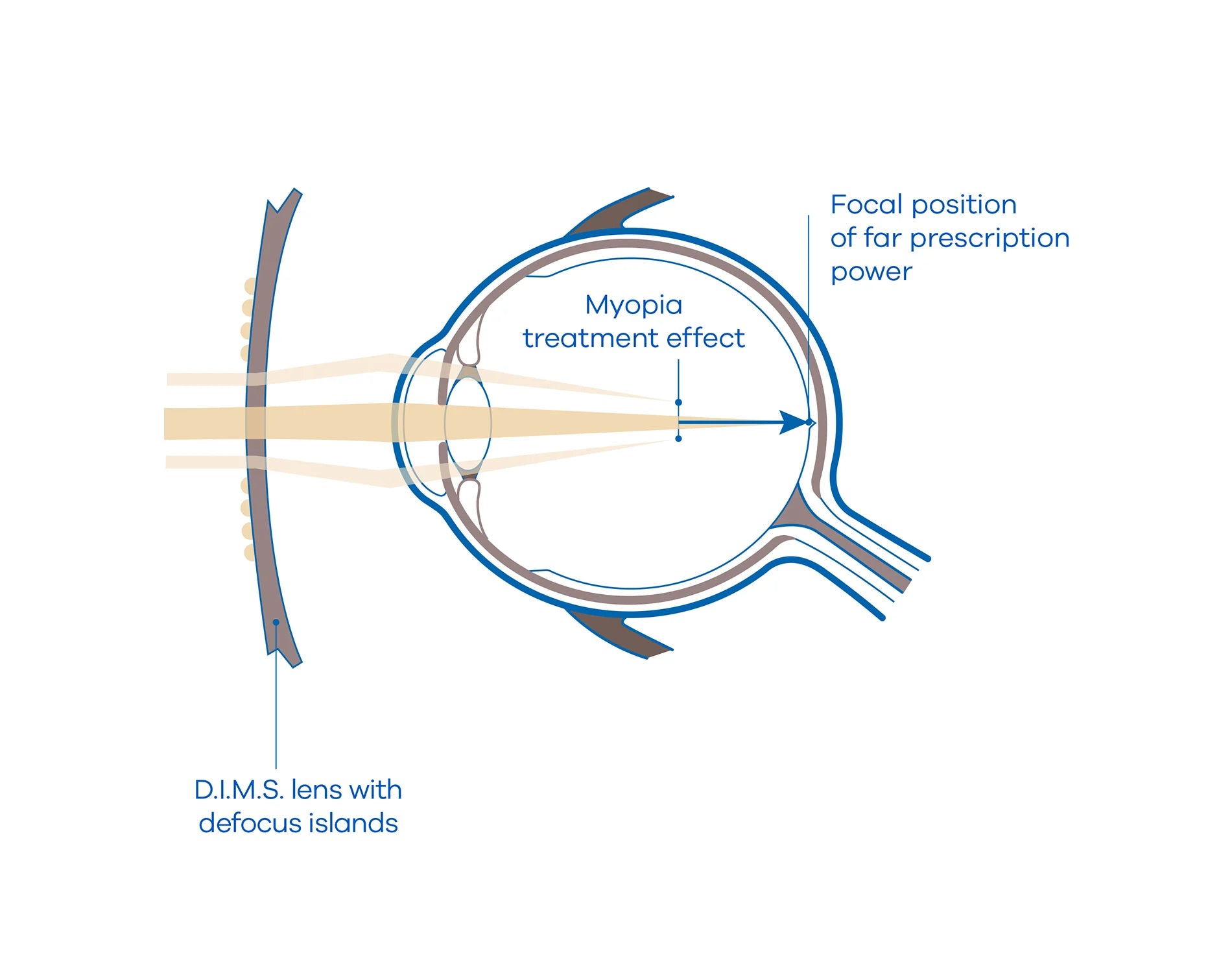 Myopia Control Options